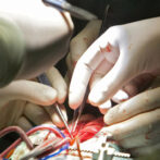 Successful revival of 30 year cryogenic processed heart